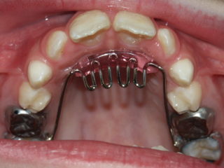 Child with tongue crib in place to prevent tongue pushing against teeth Child with tongue crib in place to prevent tongue pushing against teeth